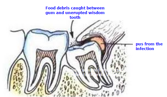 wisdom teeth food stuck